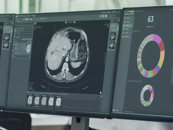 Eine Radiologin führt im Rahmen einer klinischen Studie mit mint Lesion™ eine Mehrfachzeitpunkt-Bewertung eines Leberkrebsfalls durch.